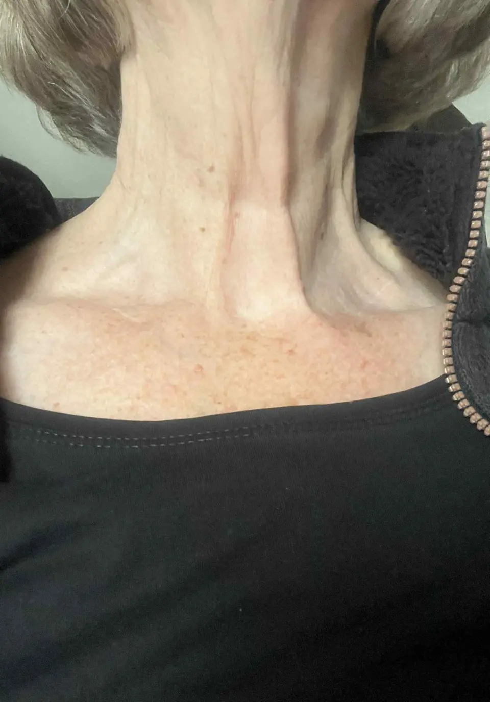 Post-op Neck Scar