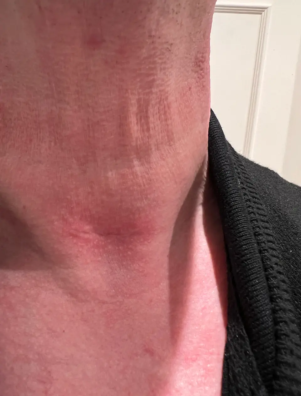 Post-op Neck Scar