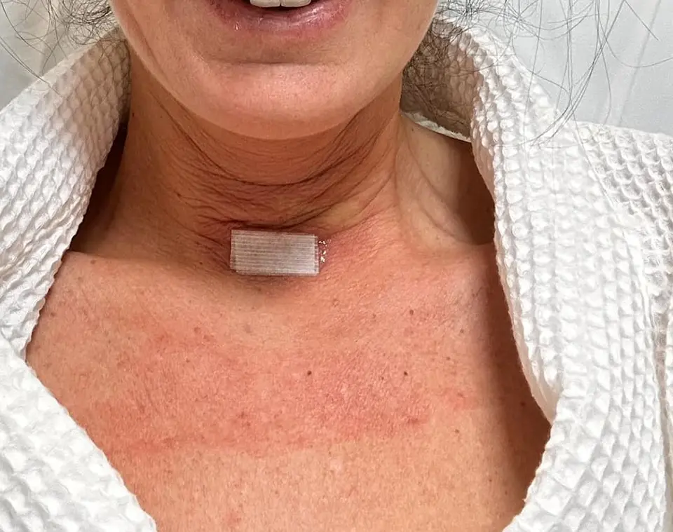 Post-op Neck Scar