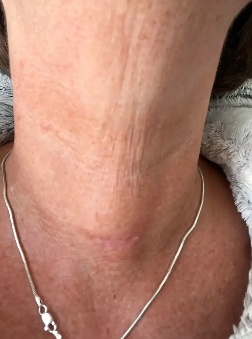 Post-op Neck Scar
