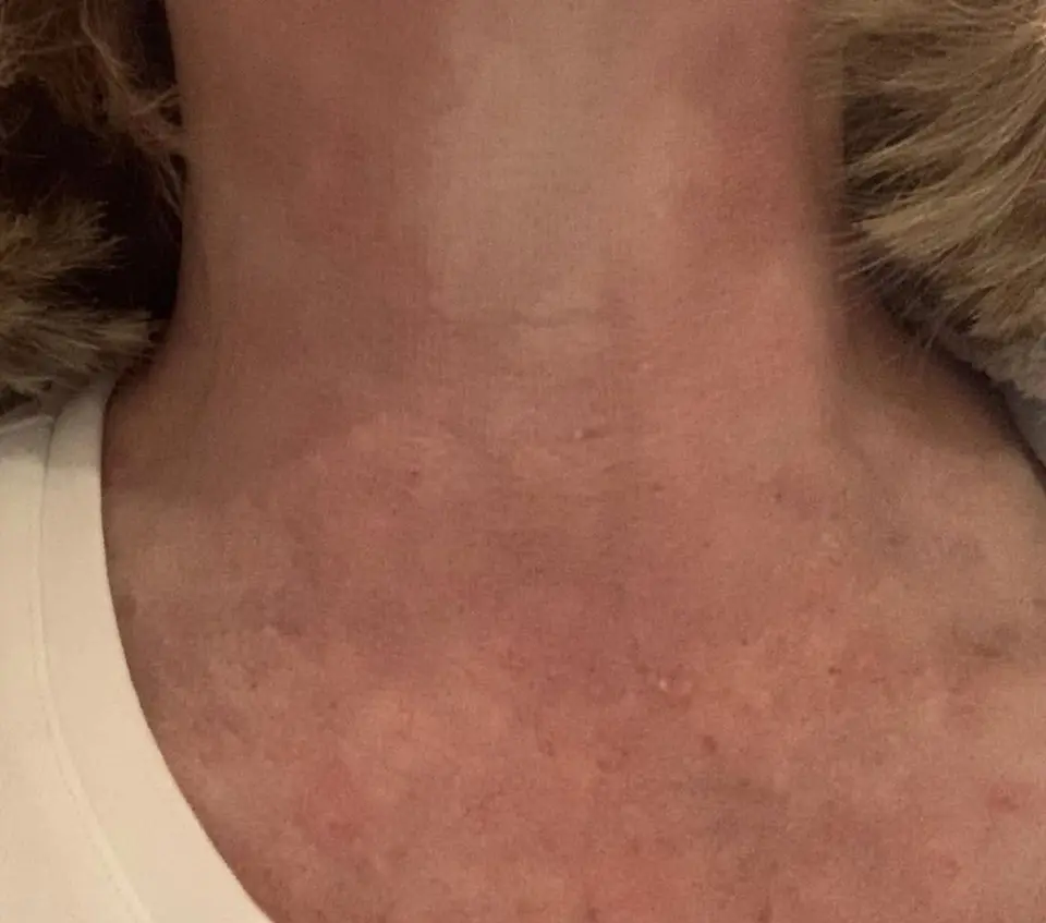Post-op Neck Scar