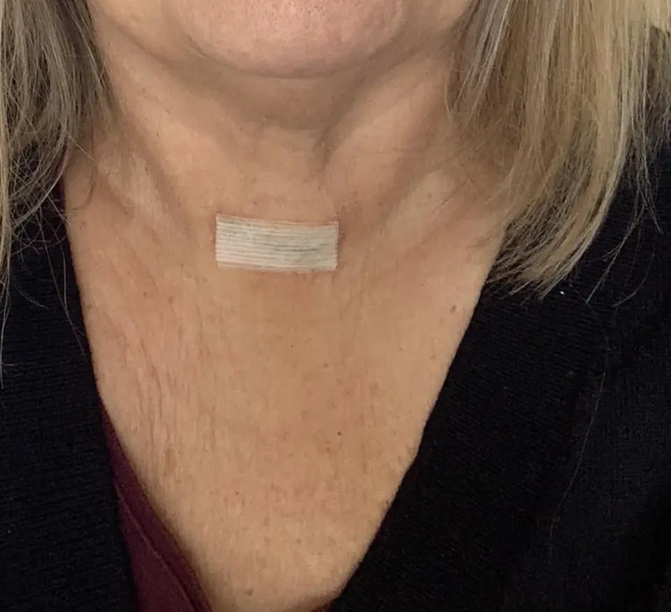 Post-op Neck Scar