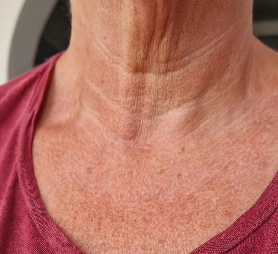 Post-op Neck Scar