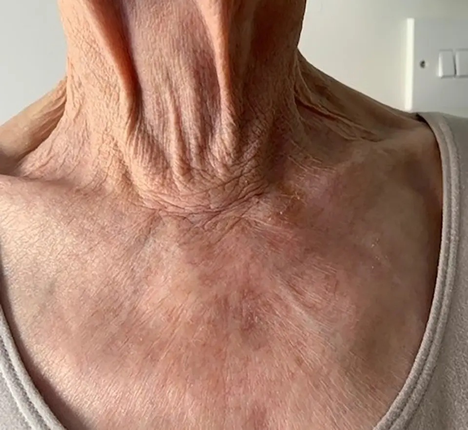 Post-op Neck Scar