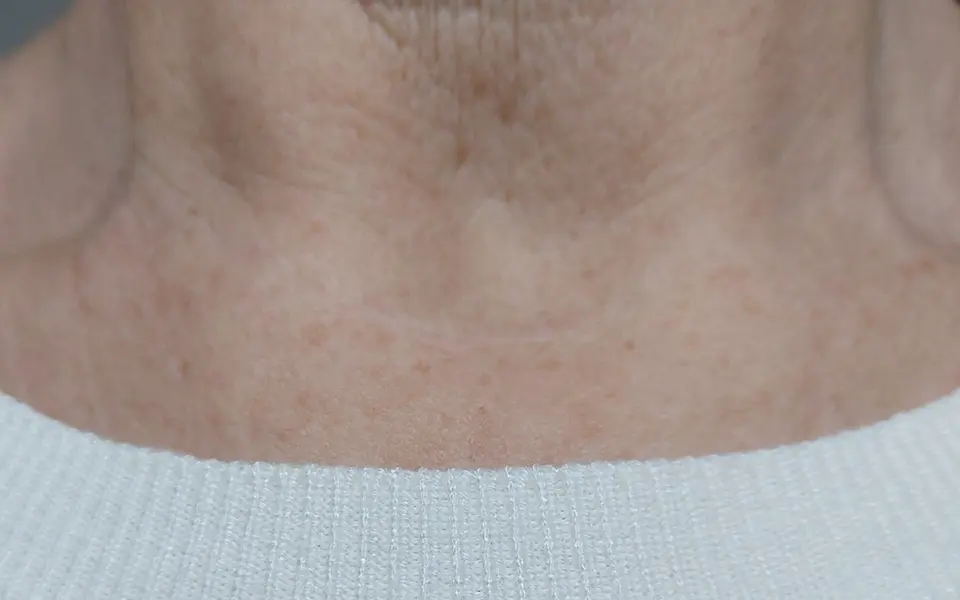 Post-op Neck Scar