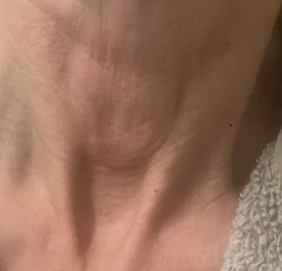 Post-op Neck Scar