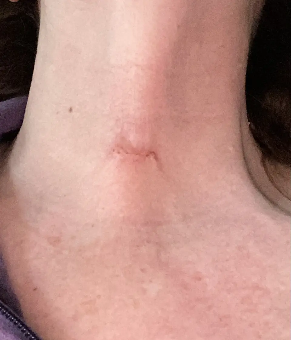 Post-op Neck Scar
