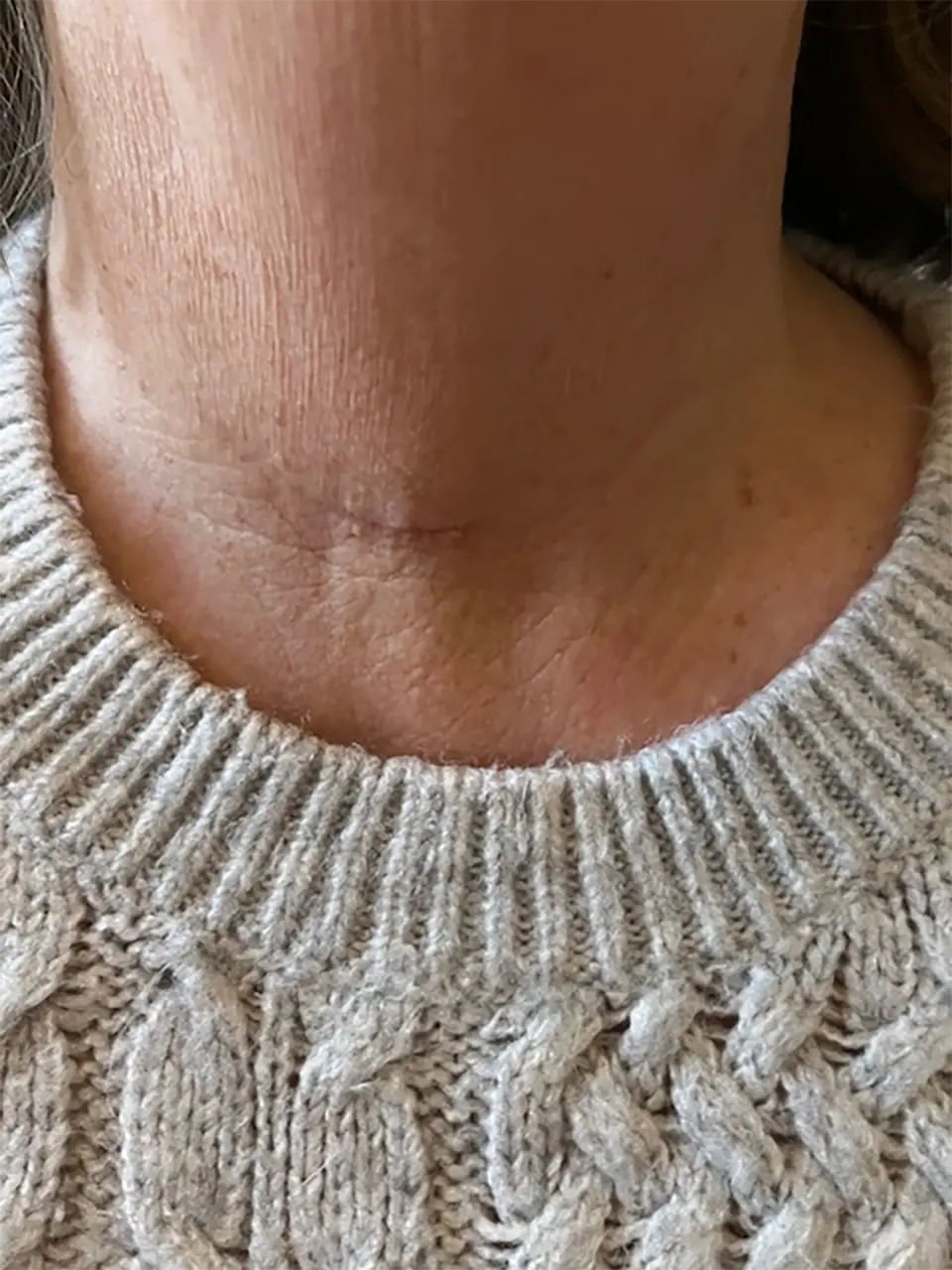 Post-op Neck Scar
