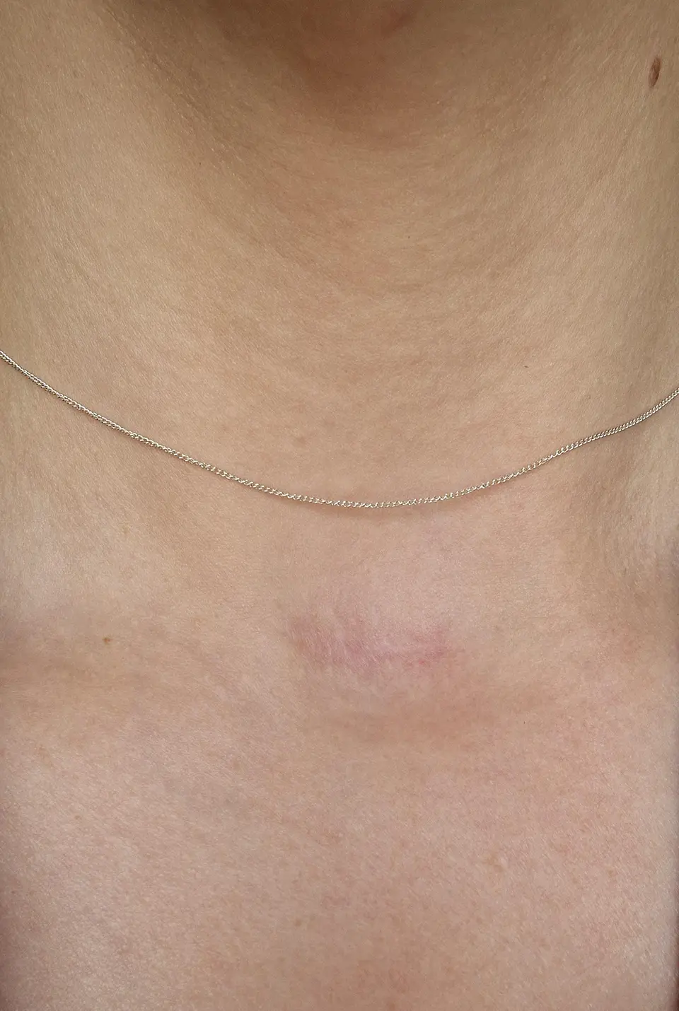 Post-op Neck Scar