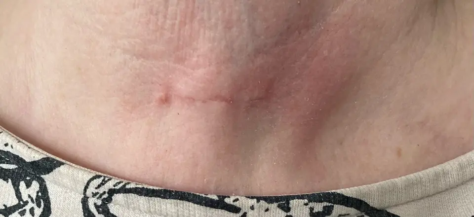 Post-op Neck Scar