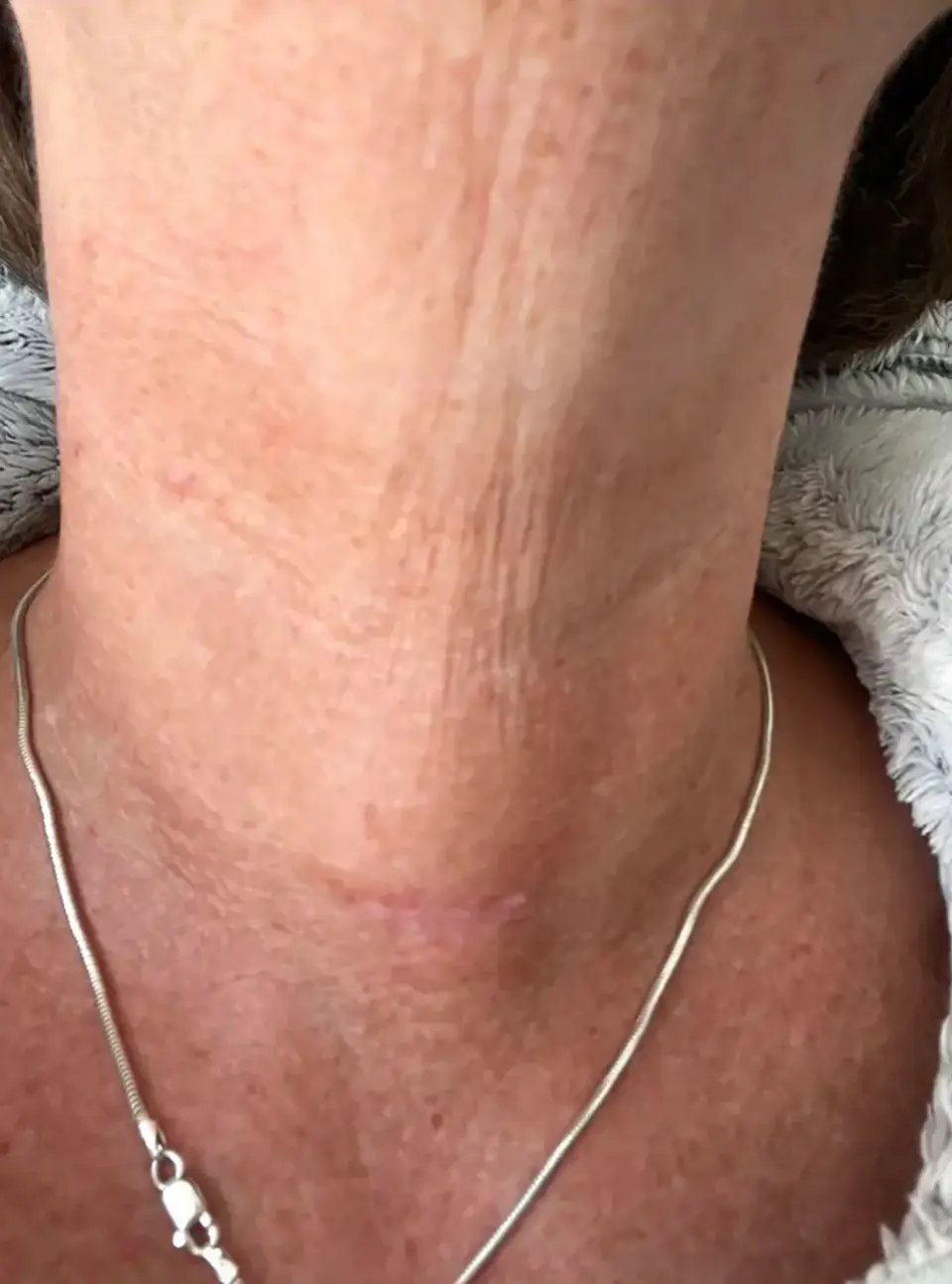 Post-op Neck Scar