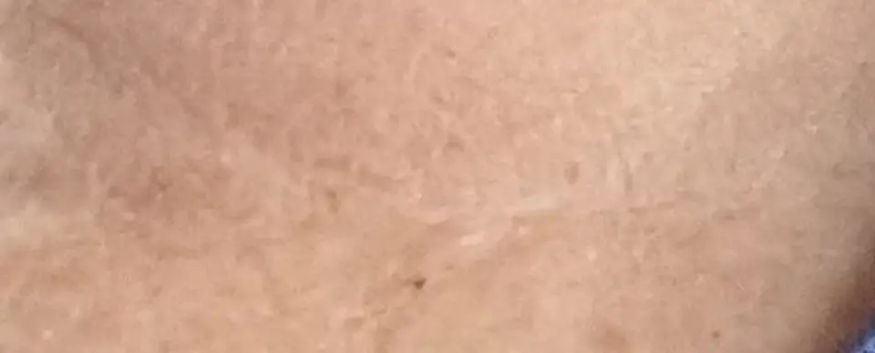Post-op Neck Scar