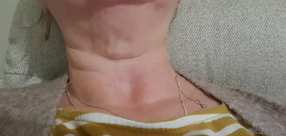 Post-op Neck Scar