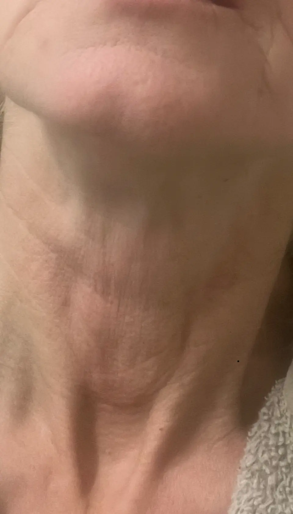 Post-op Neck Scar