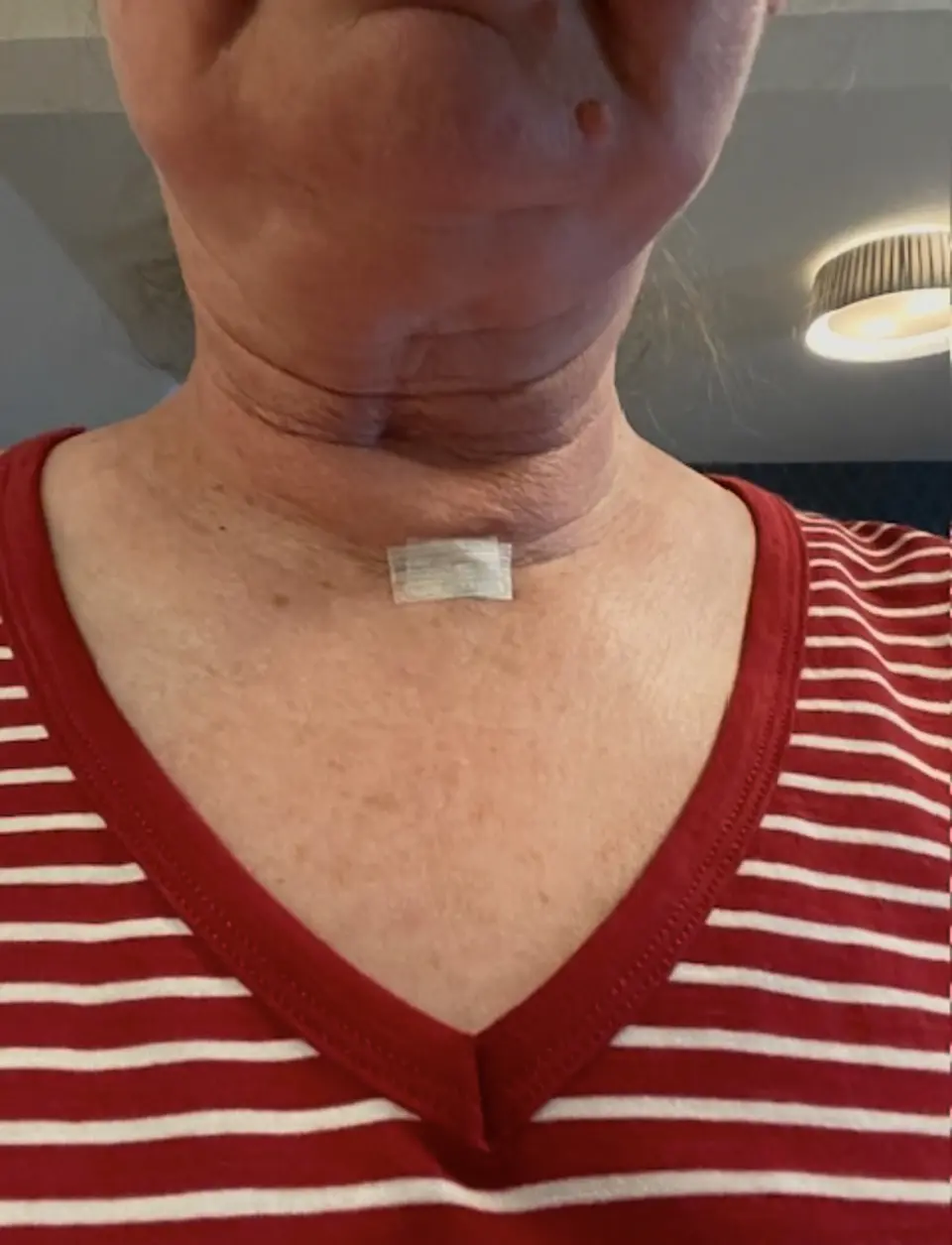 Post-op Neck Scar