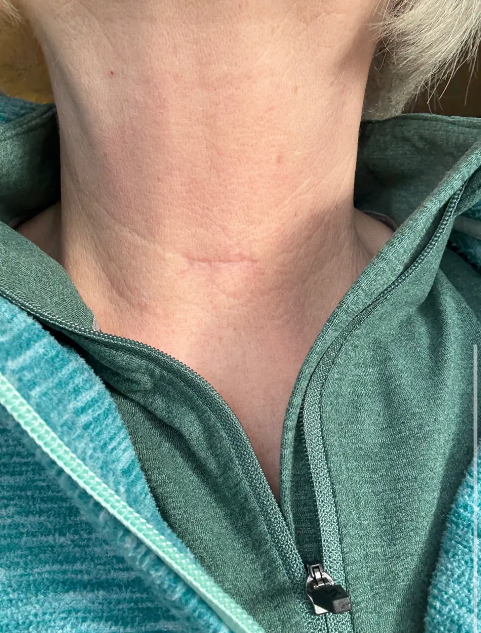 Post-op Neck Scar