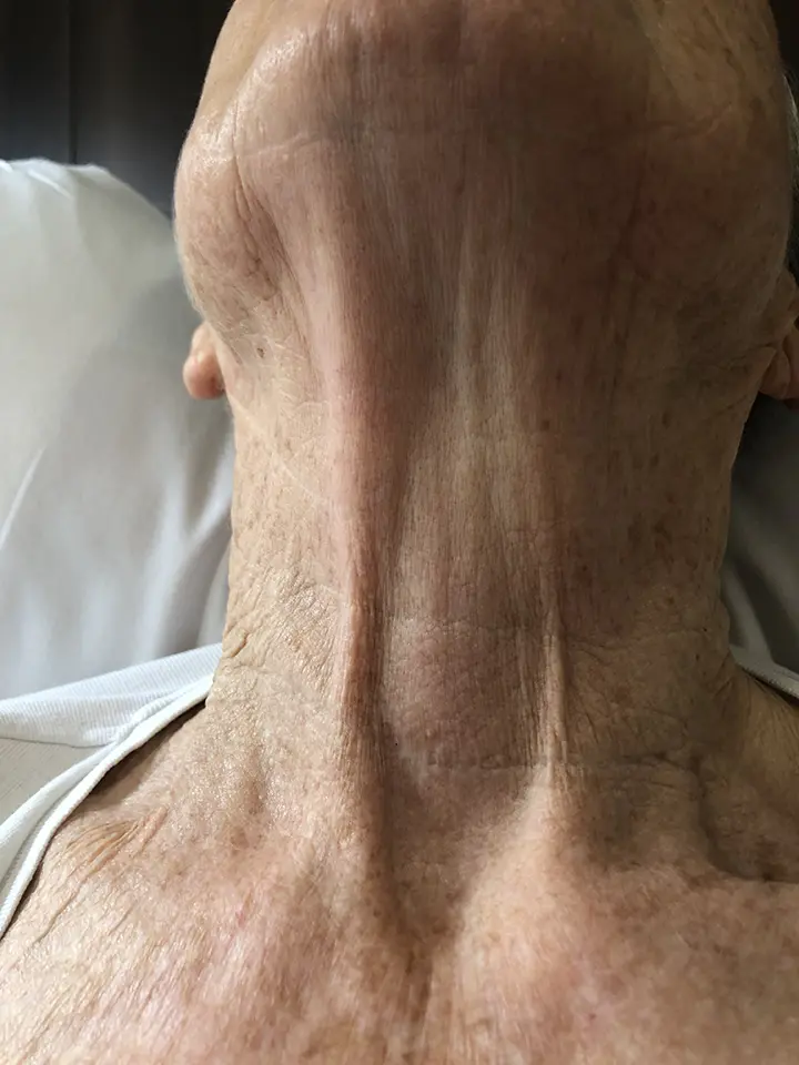 Post-op Neck Scar